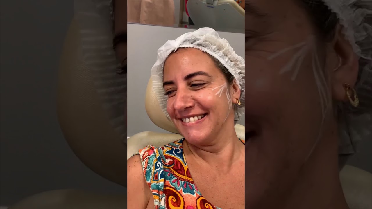 Preenchimento Facial na prática - Parte 1