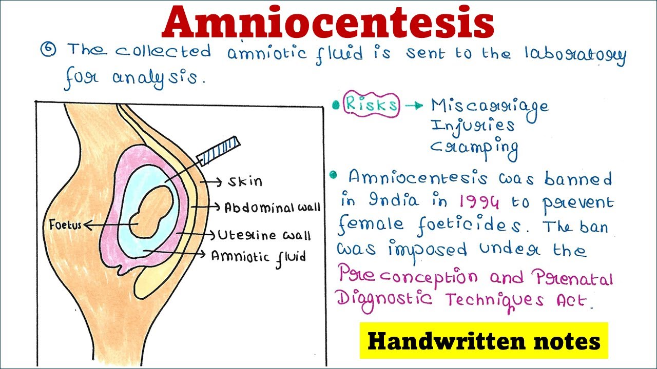 Amniocentesis