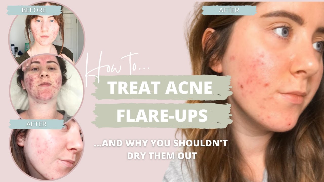 How to deal with HORMONAL ACNE FLARE-UPS | Acne Treatments