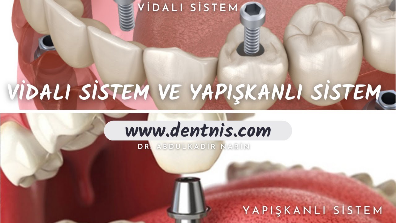 Vİdalı Sistem Ve Yapıştırma Sistem Arasındaki Fark Nedir?