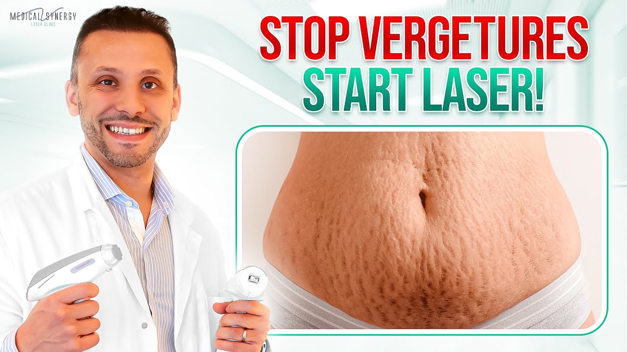 Stop aux Vergetures : La Solution Laser Qui Fonctionne Vraiment