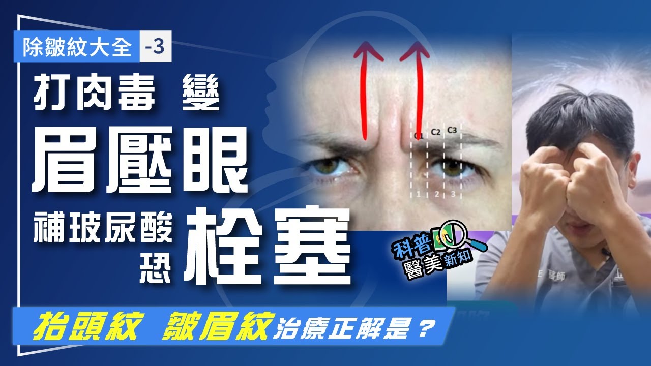 除皺紋大全-3｜抬頭紋、皺眉紋正確處理方式 竟不是打肉毒、玻尿酸？ 安全有效新選擇「新式內視鏡上額拉皮+自體筋膜回填」科普醫美新知380-20250225