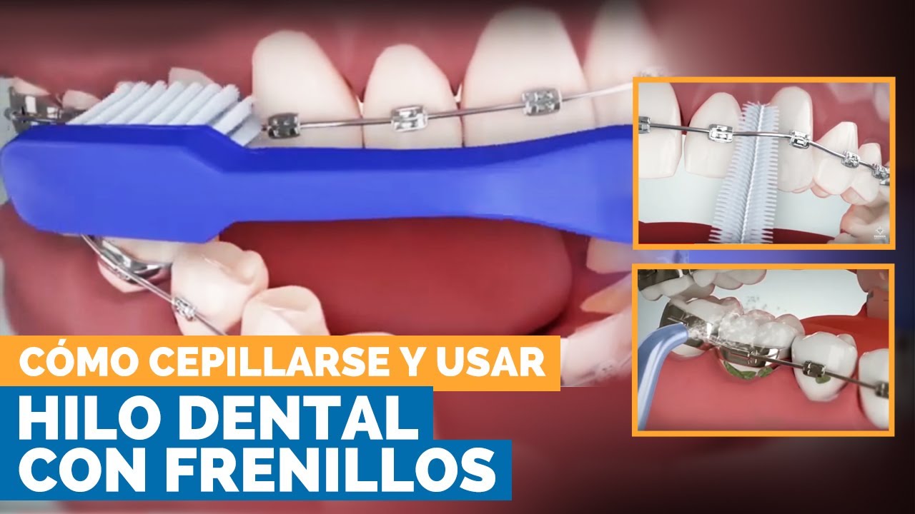 Cómo Cepillarse Y Usar Hilo Dental Con Frenos | Premier Orthodontics