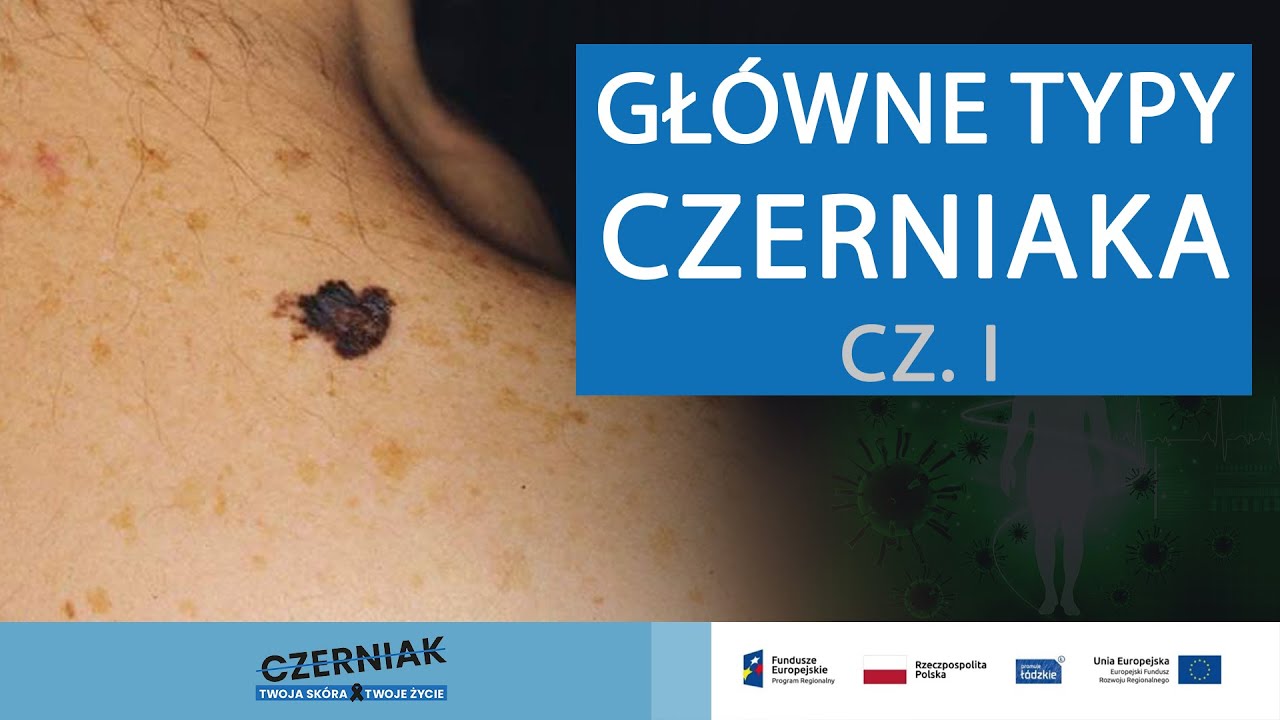 Główne typy czerniaka - cz. 1