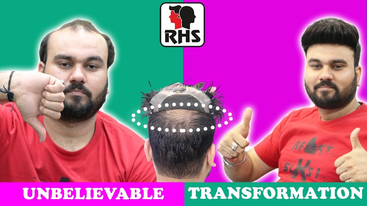 Non Surgical Hair Replacement | Clipping System | Hair Patch For Men In DELHI | Latest Video Patch |