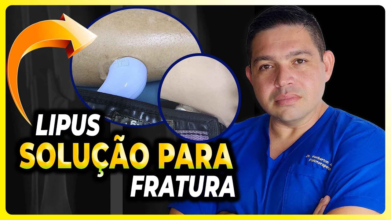 FRATURA: COMO FAZER O OSSO COLAR MAIS R&Aacute;PIDO | LIPUS