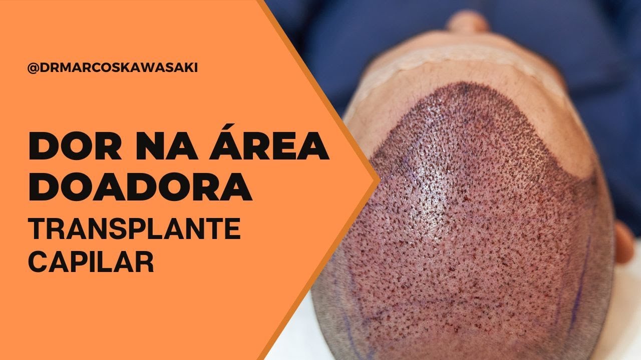 Área doadora doendo bastante pós transplante capilar, é normal?