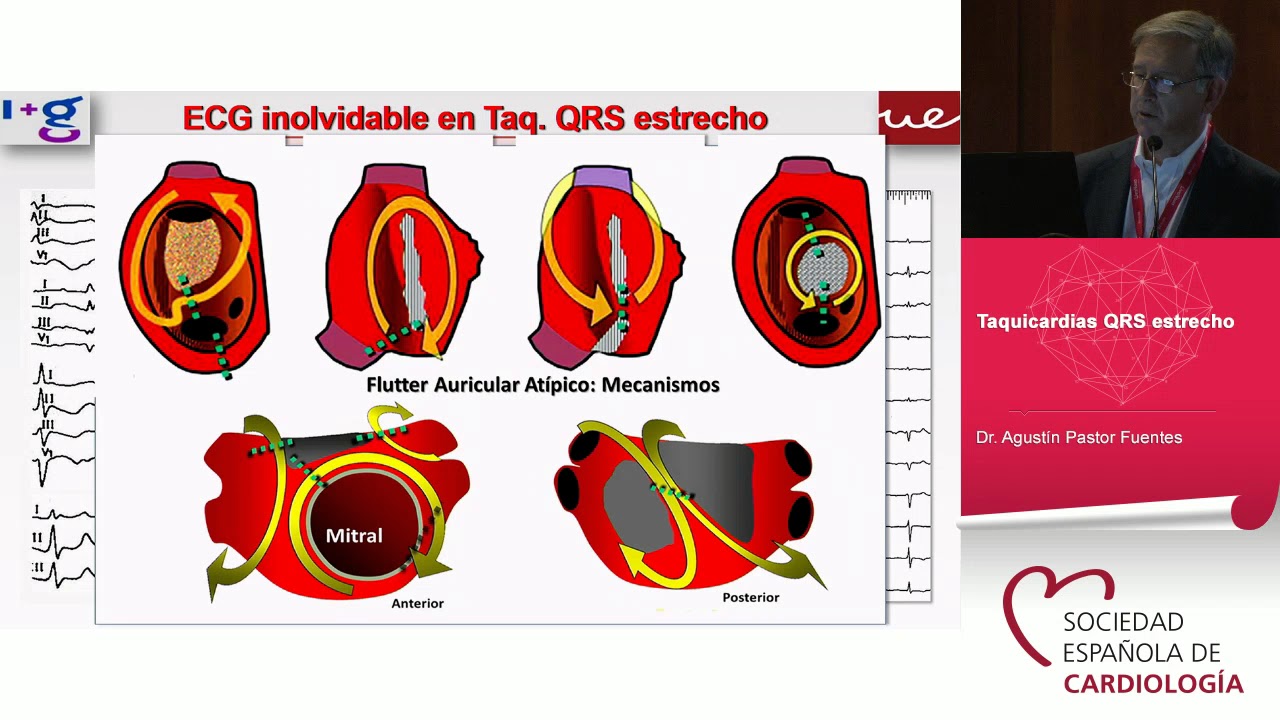 Los electrocardiogramas que no puedes olvidar