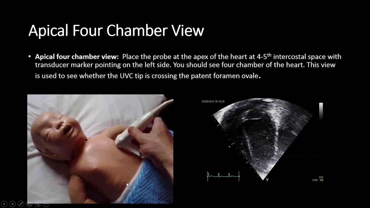 UVC assessment by Ultrasound