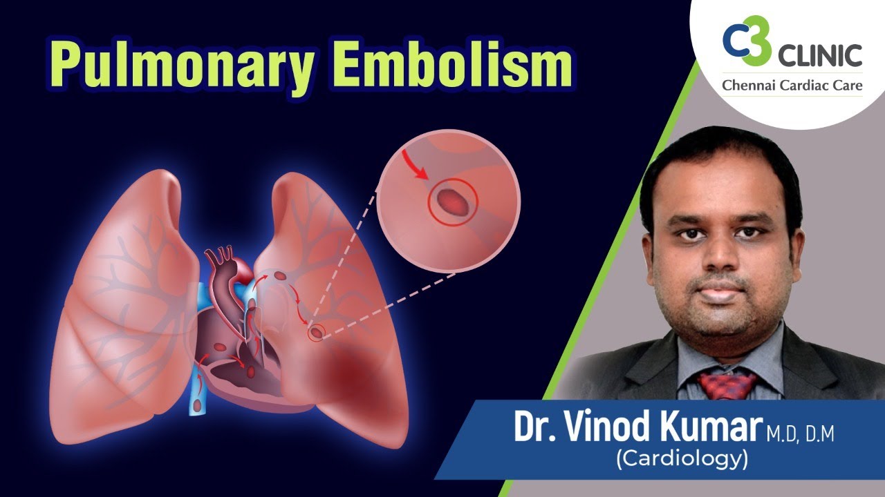 நுரையீரல் தக்கையடைப்பு என்றால் என்ன? | Pulmonary Thromboembolism Explained In Tamil |Dr. Vinod Kumar