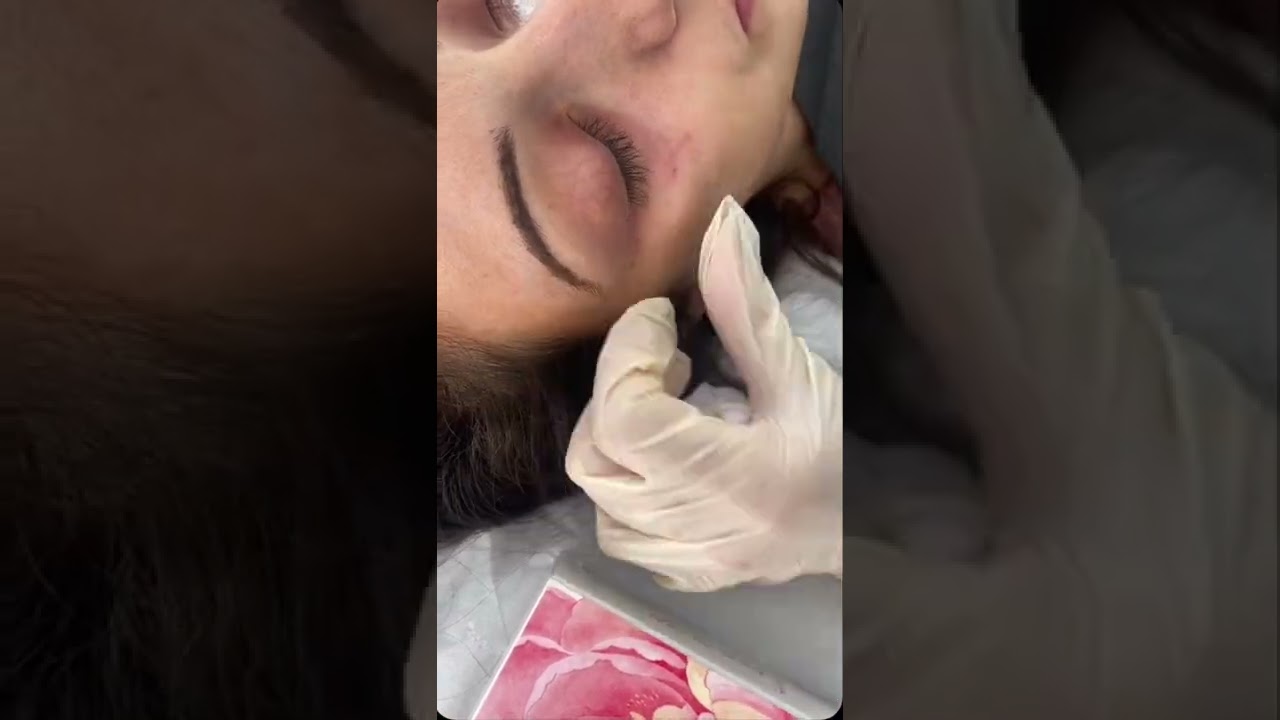 Pink glow mesotherapy for dark circles