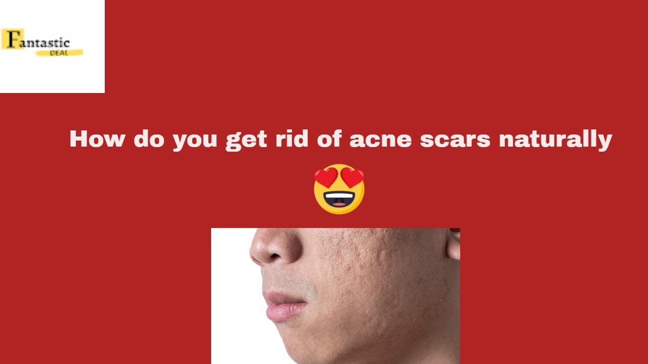 How do you get rid of acne scars naturally