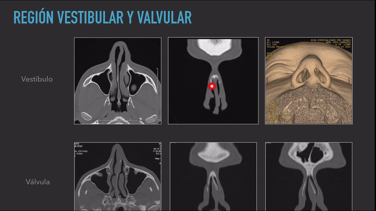 Anatomía Senos Paranasales  Parte 1 Radiología Diagnóstico por Imagen