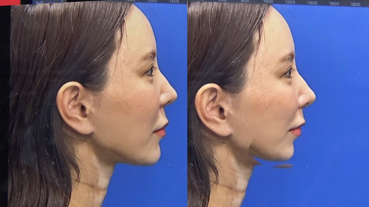 骨切りのシミュレーションしてみた【アマソラ】