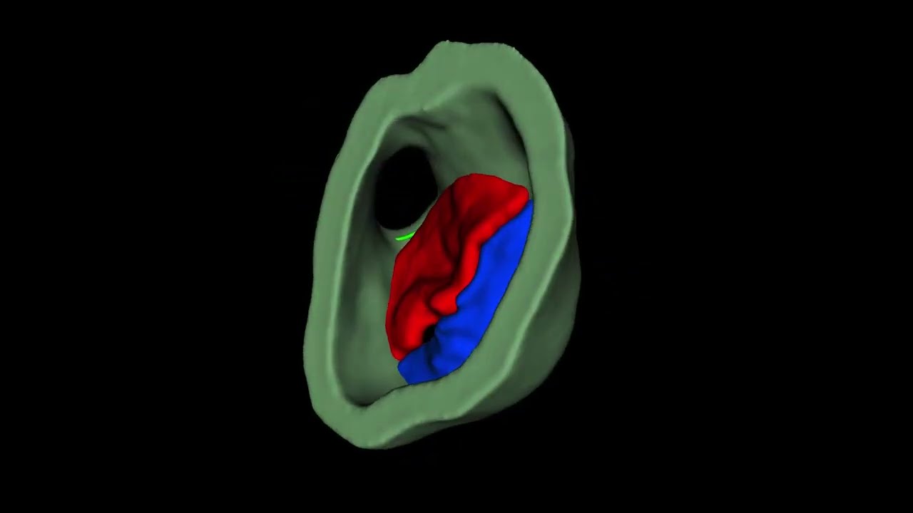 Visualization of Multimodality Imaging for the Planning of Transcatheter Mitral Therapies