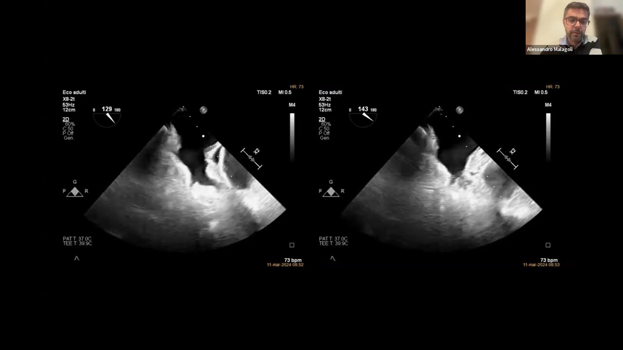 ECOCARDIOGRAMMA TRANSESOFAGEO VALORE INCREMENTALE NEI DIVERSI SETTING CLINICI