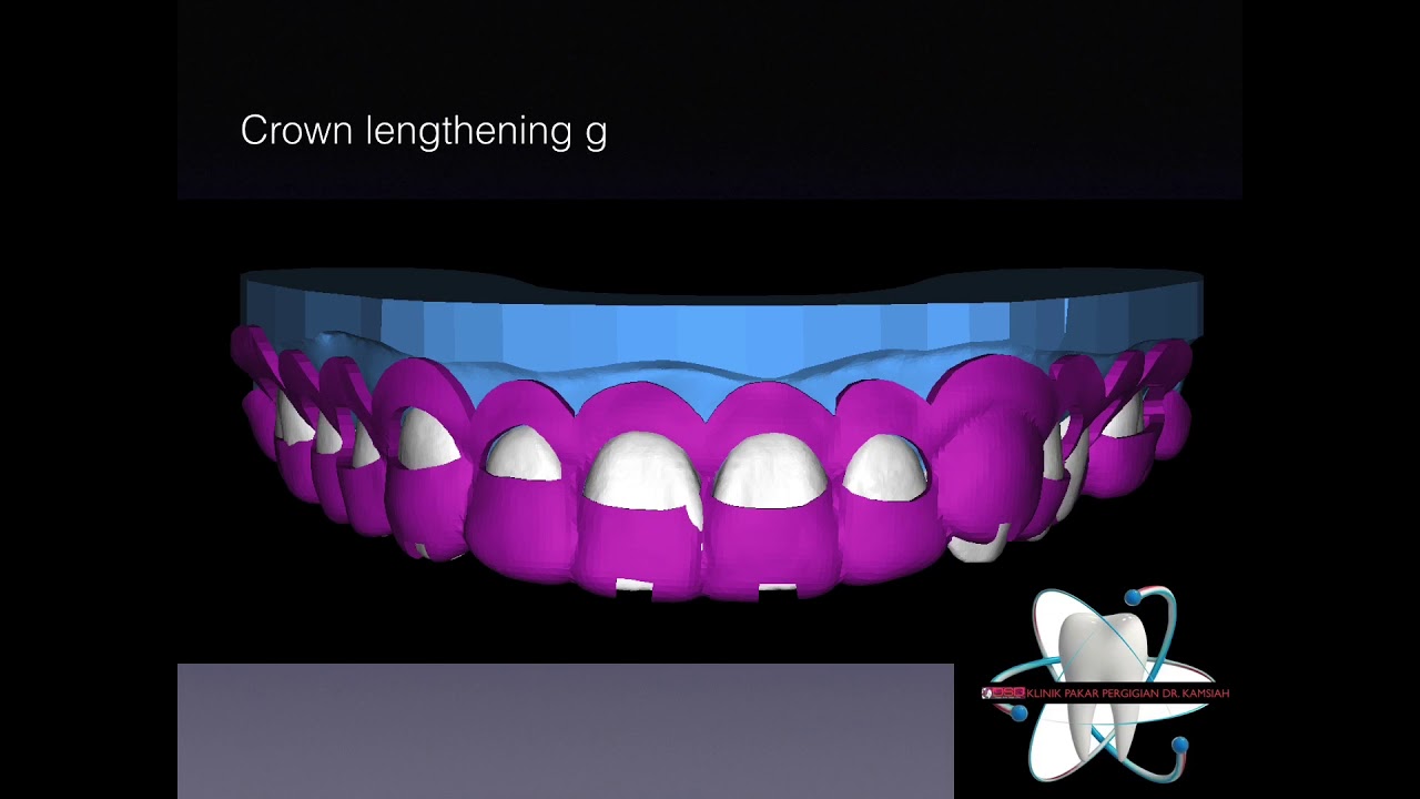 Digital Crown lengthening