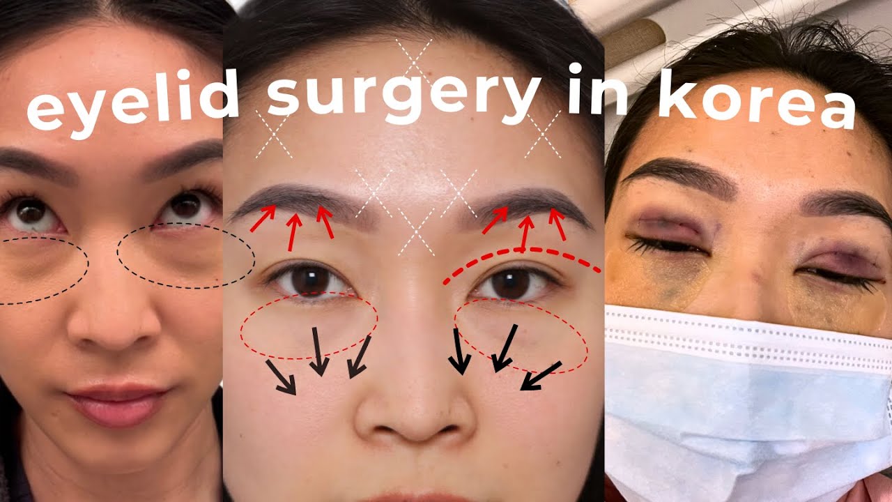 Пластика век в Корее Dream Plastic Surgery