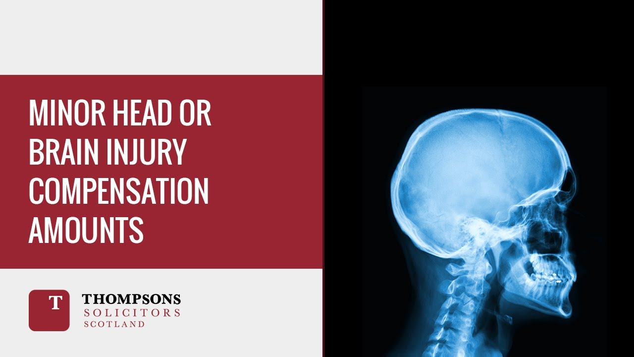 Minor Head or Brain Injury Compensation Amounts