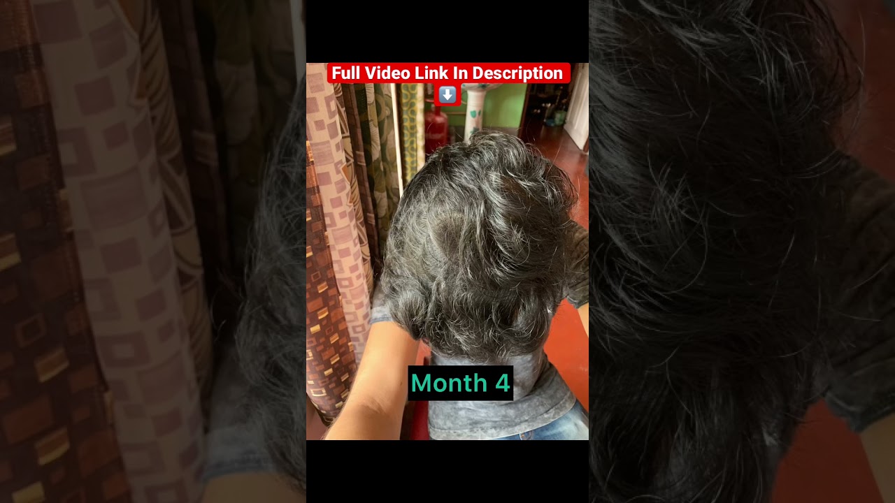 Redensyl Hair Before After | 9 Months Review | Minimalist 18% Hair Serum Review | #redensyl #hair