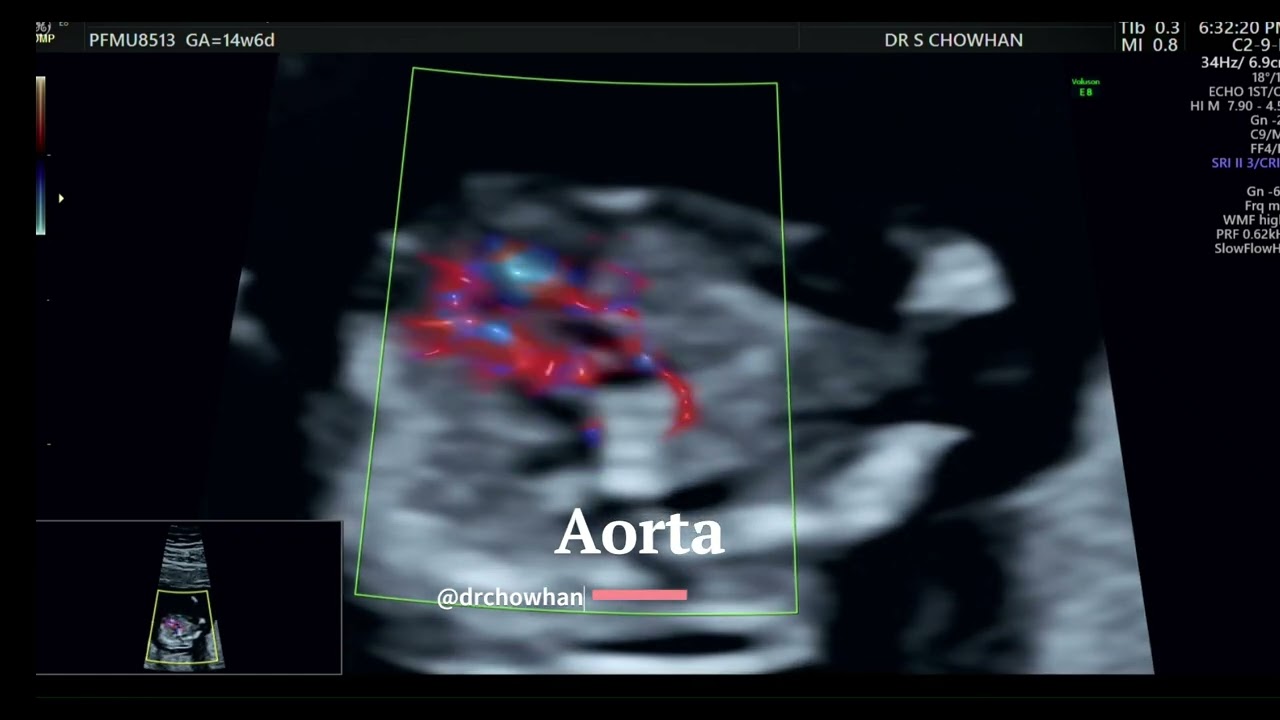 FETAL ECHOCARDIOGRAPHY in first trimester