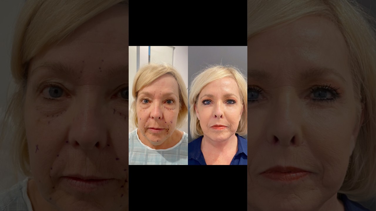 FACELIFT TRANSFORMATION - HER CONFIDENCE IS BACK! #plasticsurgery