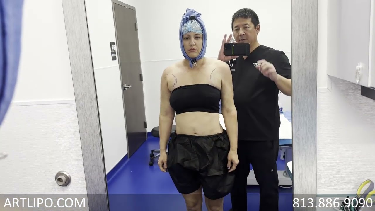Arm Liposuction Immediate Results| Celebrity Arms&trade; High Definition Lipo 360&deg; Arms | Expert Dr. Su