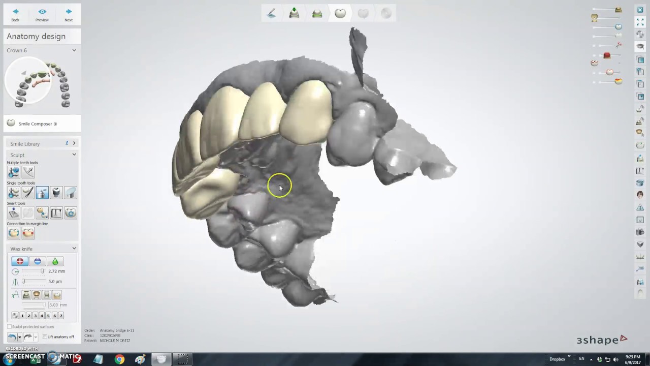 3Shape design for 6 units bridge from Carestream scan