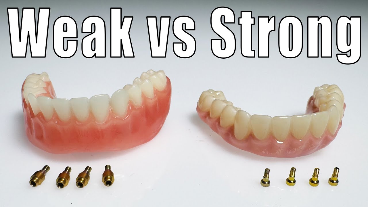 Best Types of Implants (Explained)
