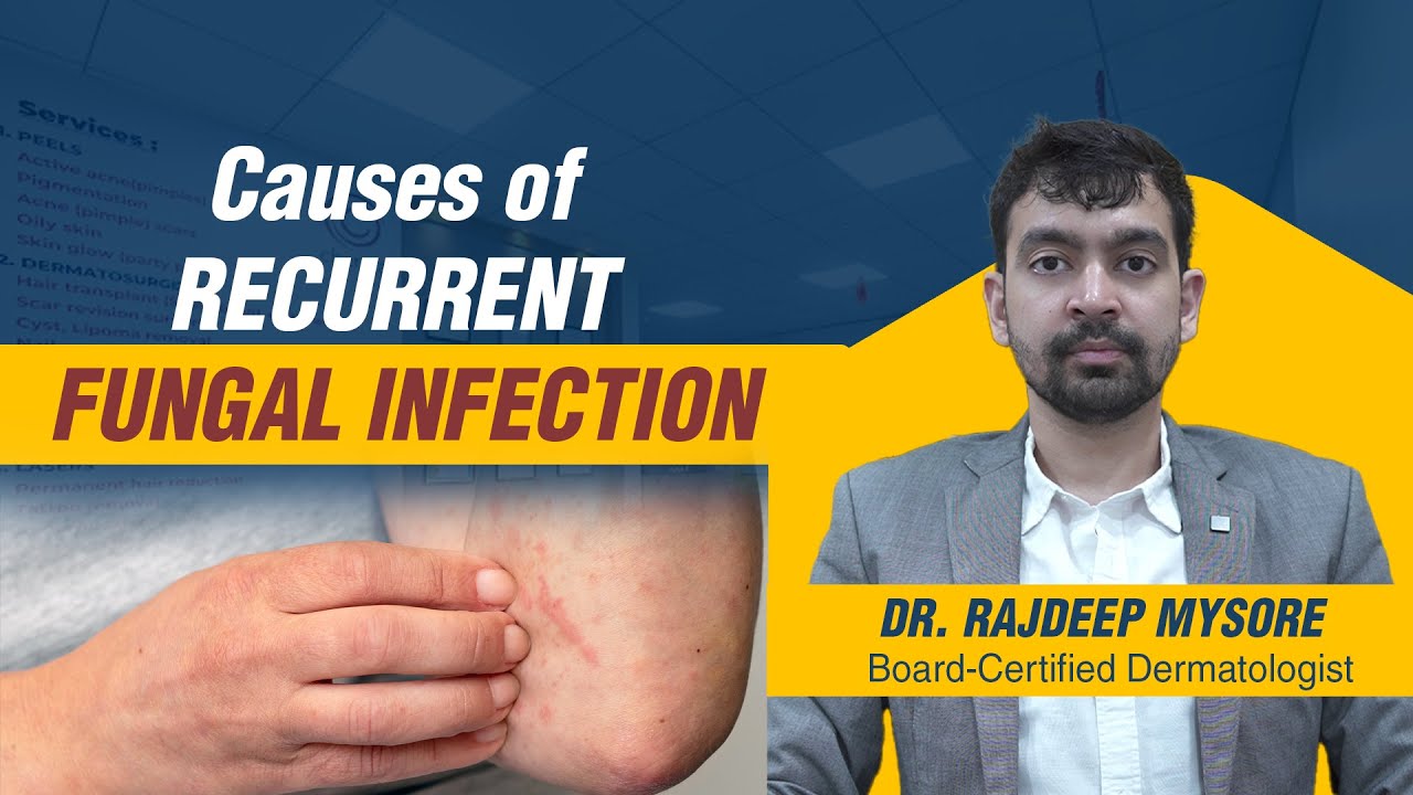 Common Causes of Recurrent Fungal Infection - Dr. Rajdeep Mysore | Charma Clinic