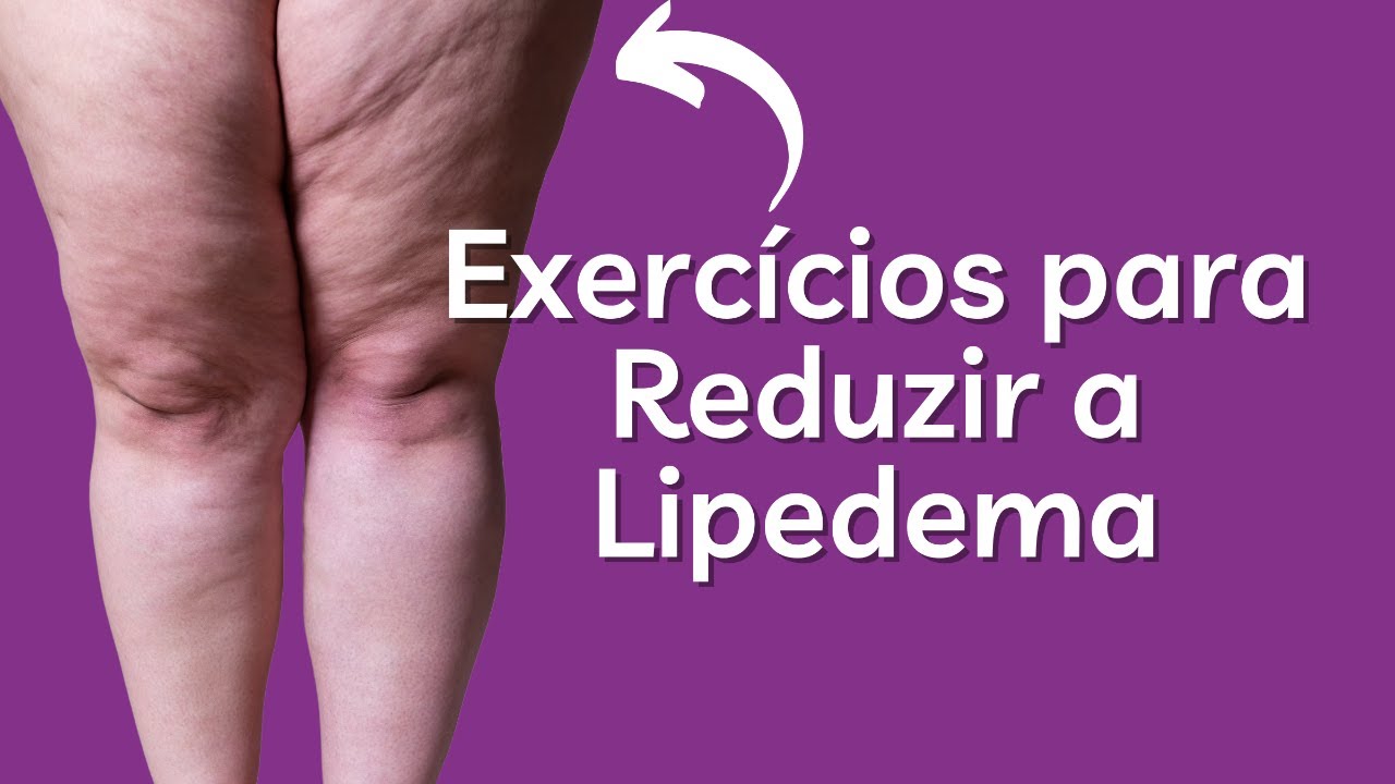 Exercícios para Reduzir a Lipedema + Respondendo suas Dúvidas