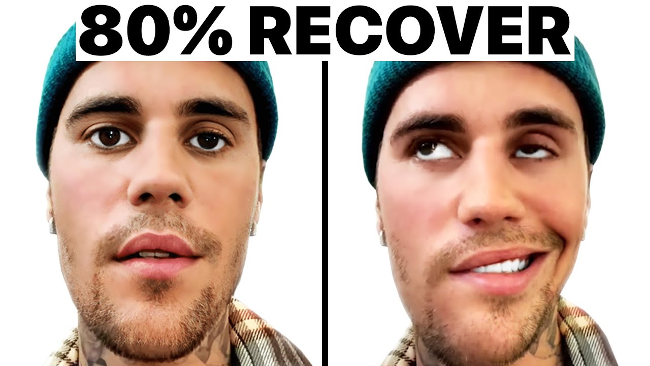 Justin Bieber Ramsay Hunt Syndrome | Doctor Reacts