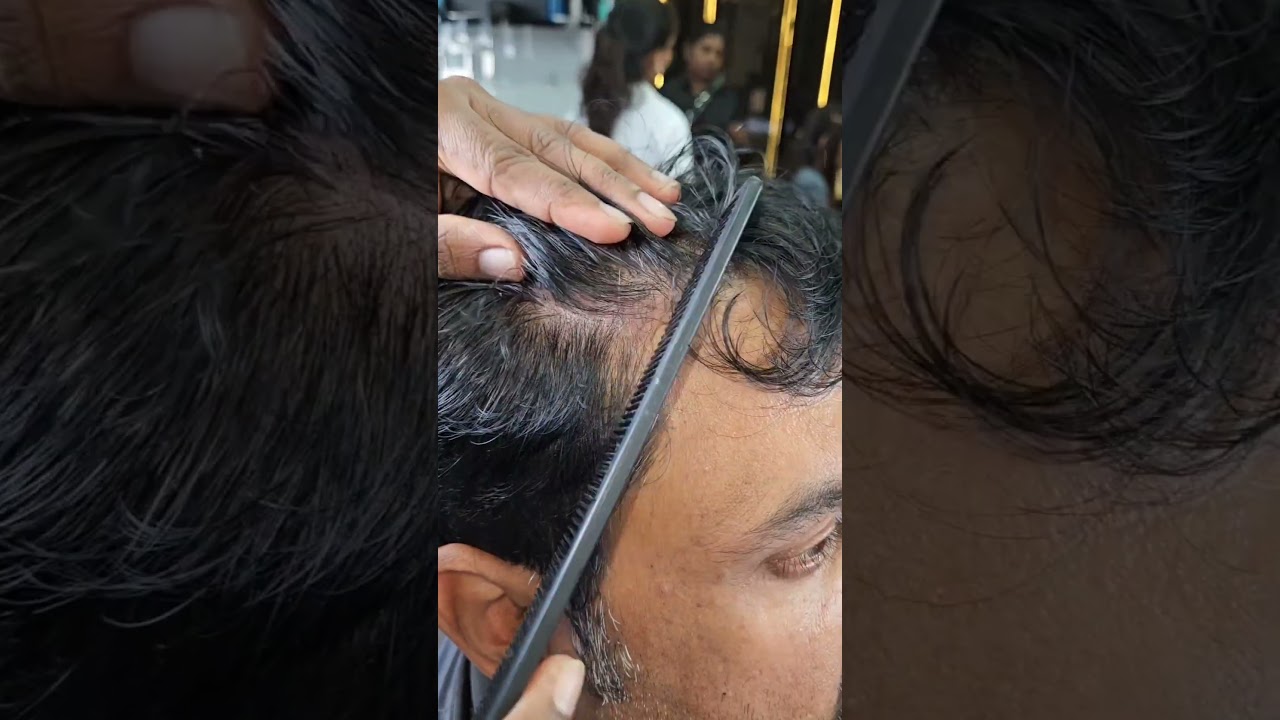 Discover the Stunning Before and After Results of Our Ayurvedic Anti-Dandruff Treatment!
