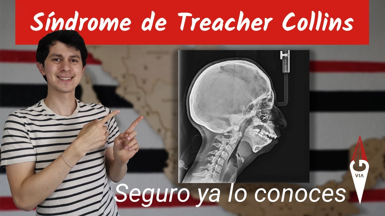 Síndrome de Treacher Collins | Seguro ya lo conoces | Primera vez que hablamos de un síndrome