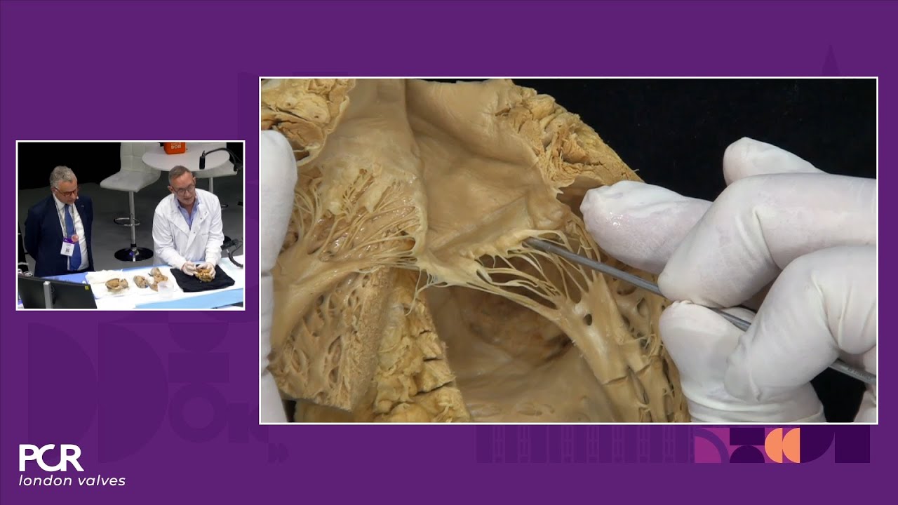 Unlocking the potential of mitral and tricuspid valves clipping - PCR London Valves 2024