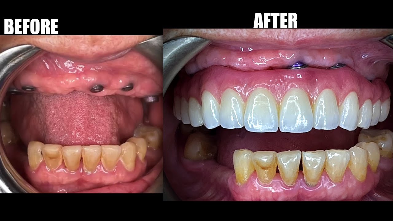 Completely New Smile In Just 2 Visits