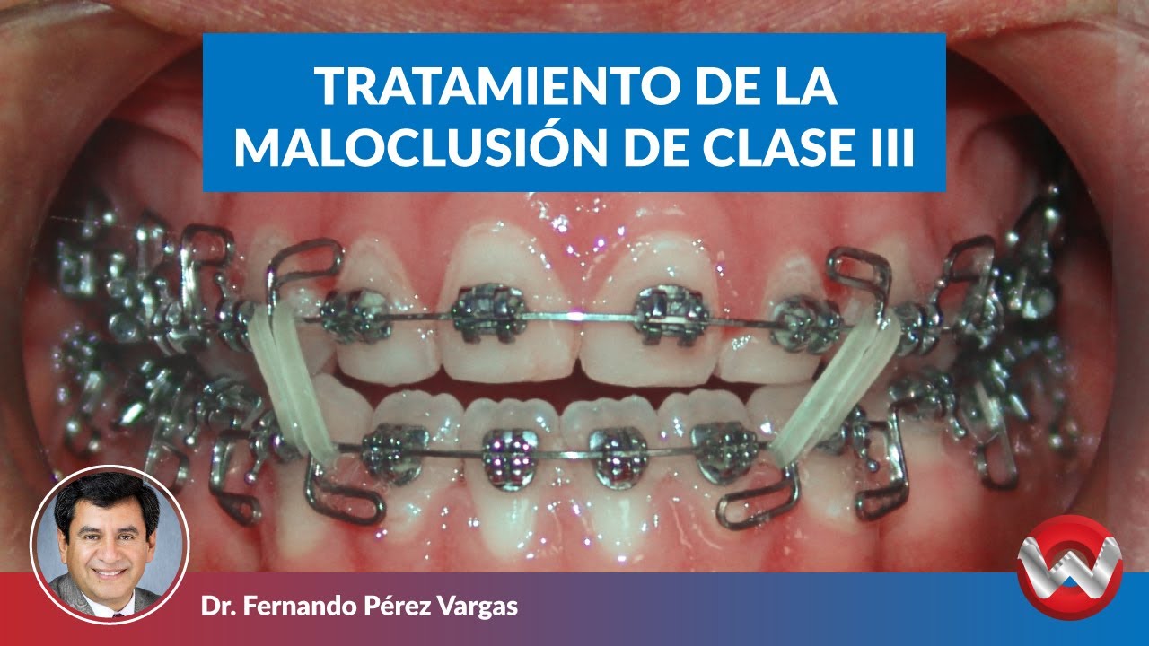 Tratamiento de la maloclusión de clase III