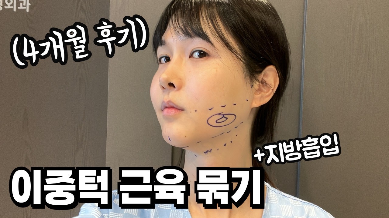 양악 후 12년만에 이중턱 수술했어요
