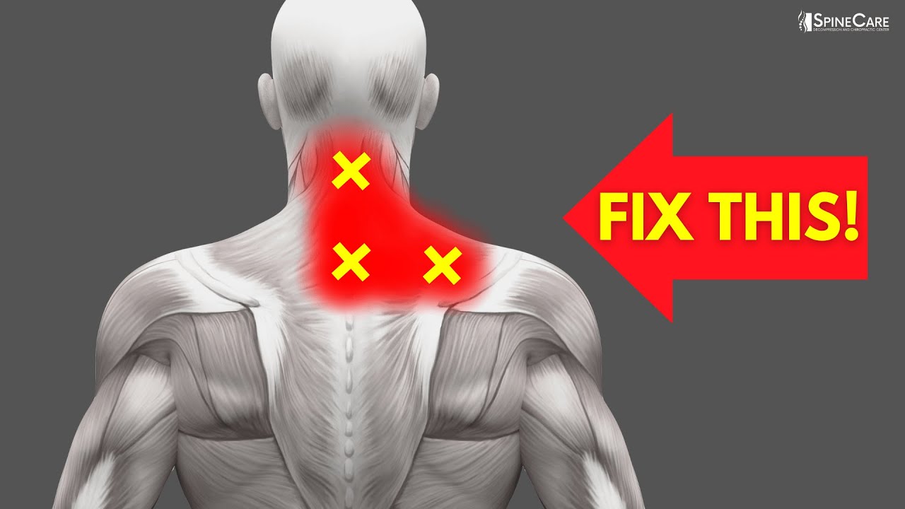 How to Fix Neck and Upper Back Pain FOR GOOD