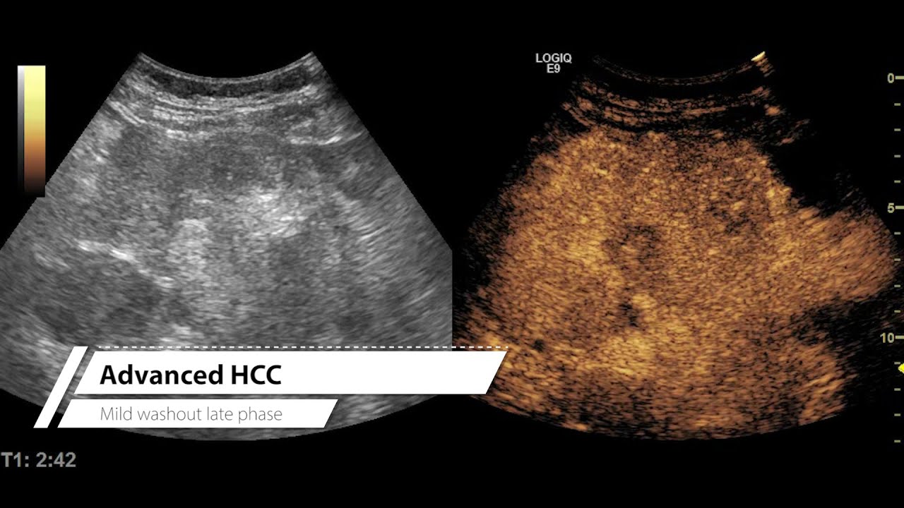 Let's learn CEUS #002 - advanced HCC