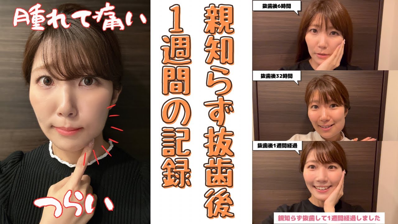 【腫れて辛かった1週間】横向きに埋まっていた歯を歯茎切開して砕きました【親知らず抜歯後経過】