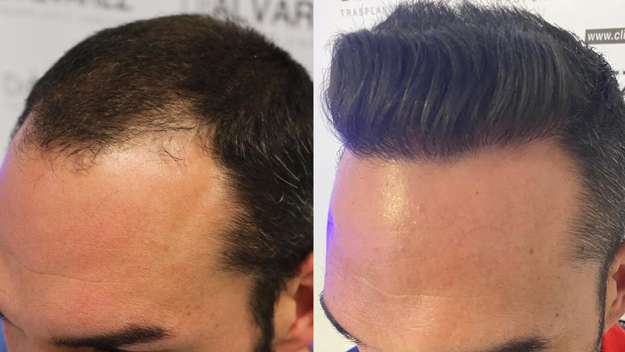 TRASPLANTE CAPILAR 2.520 UF's - Dr XAVIER ALVAREZ - CASOS REALES de DOCTORES