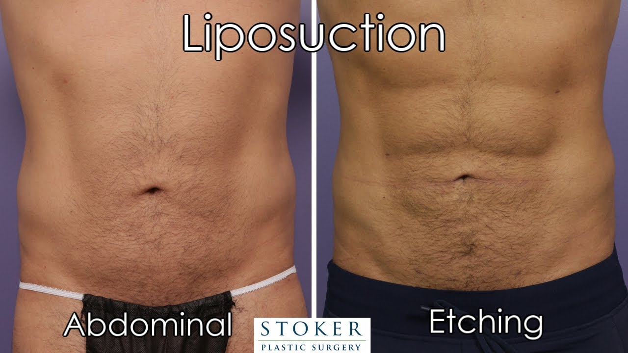 Liposuction Los Angeles: Top Plastic Surgeon Dr. Stoker Discusses Keys to Abdominal Etching