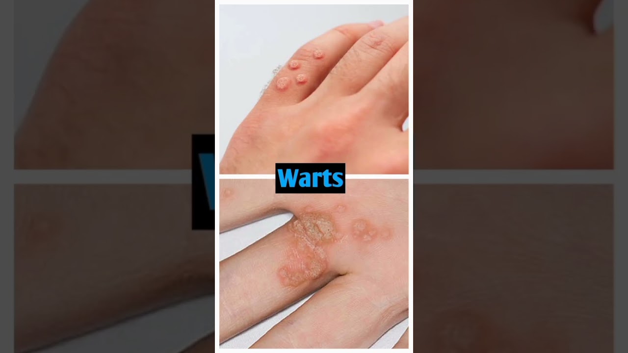 Natrum Mur 3x #homeopathy #medicine #shorts #health