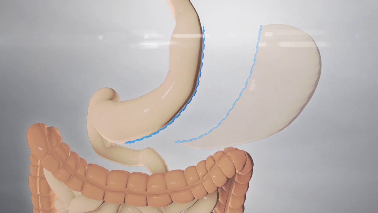 Sleeve Resection