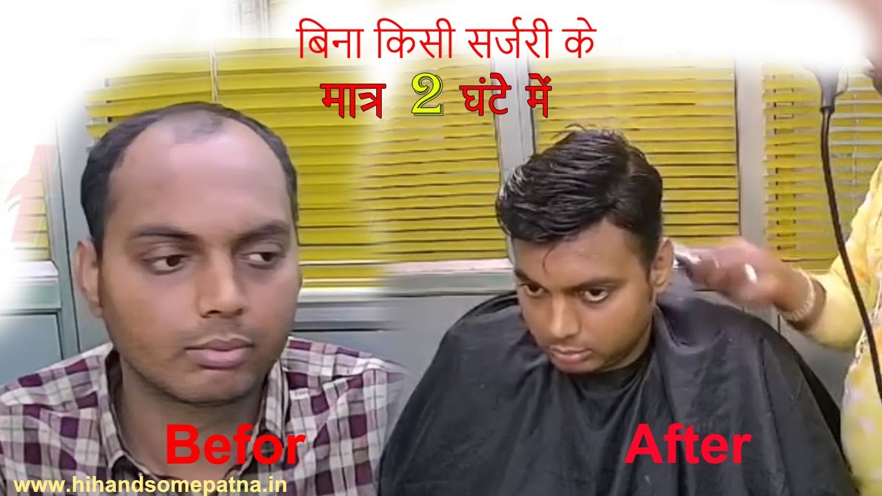 Hair Wig in Bhagalpur I Hair Patch in Bhagalpur I Hair Bonding in Bhagalpur II Alopecia Hair Loss