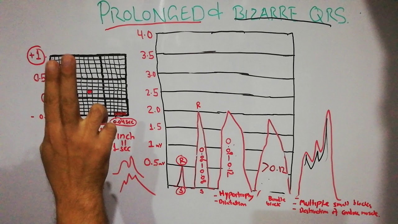 CVS physiology lecture 37 || Bizarre and prolonged QRS complex