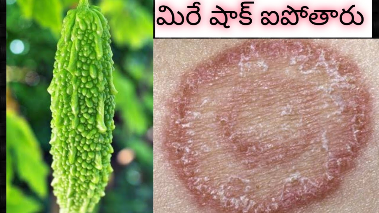 భయంకరమైన భరించలేనంత Fungal Infection ఉన్న సరే ఒక 2 రోజులు ఇది రాయండీ ఇక మీ పక్కకి కూడా రాదు