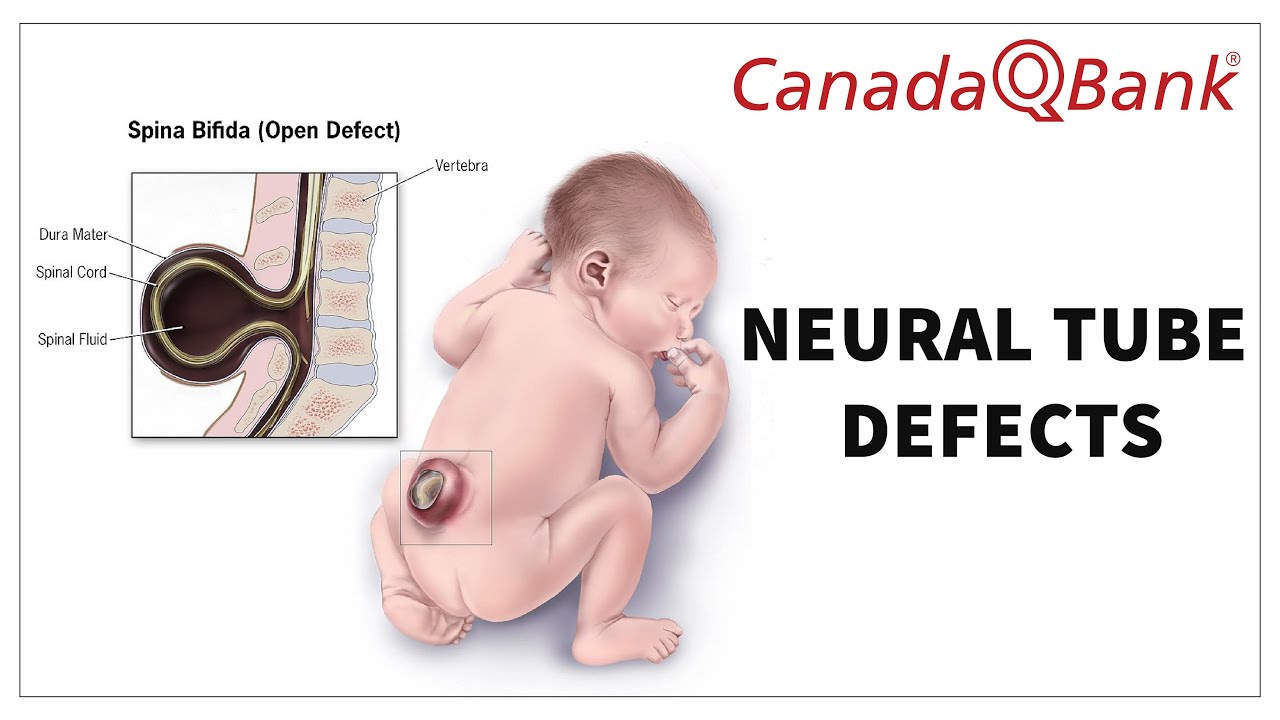 Neural Tube Defects (NTDs): Types, Causes & Prevention | High-Yield Embryology | CanadaQBank
