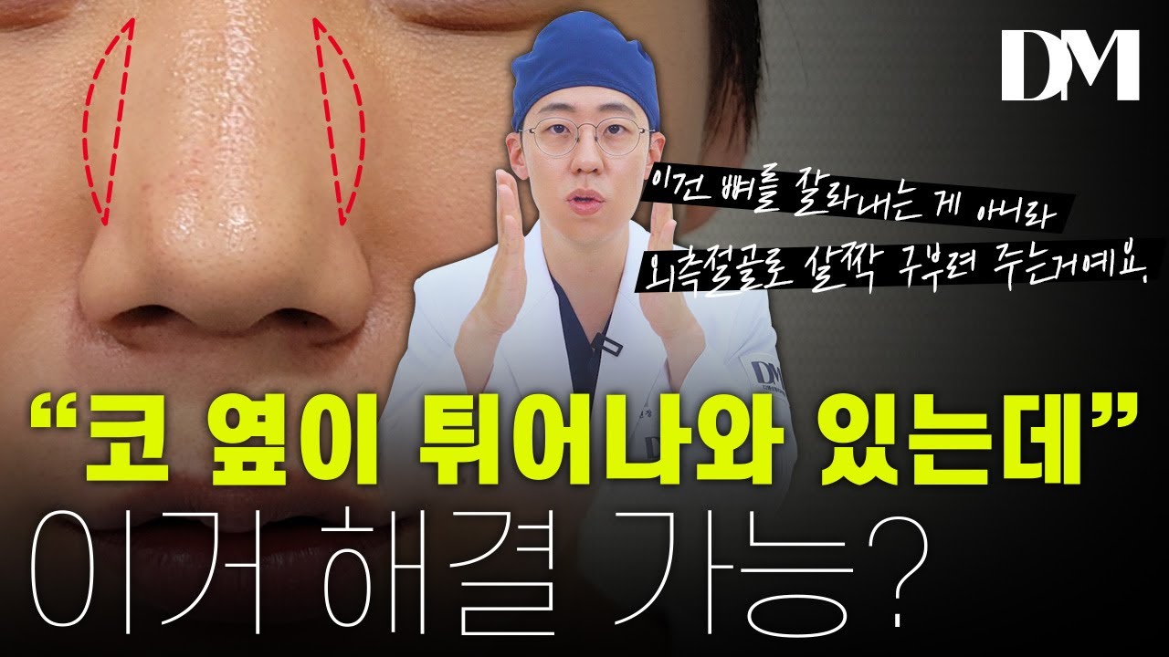 콧대 옆이 튀어나와있는 분들 정말 많으실 겁니다. 이거 고민이셨던 분들은 꼭 보세요!!!    #외측절골 #코성형 #내측절골